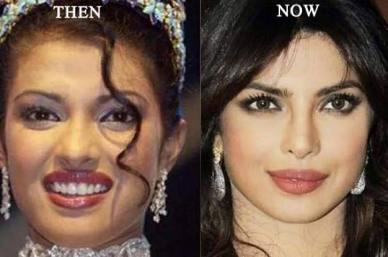 Due To Wrong Nose Surgery Priyanka Chopra Loses Big Films